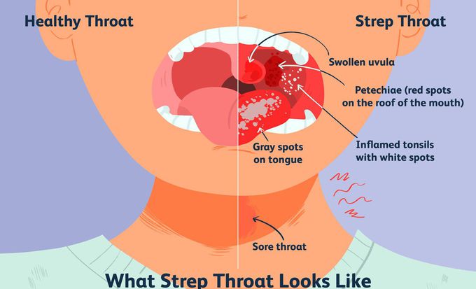 Cause of Strep throat