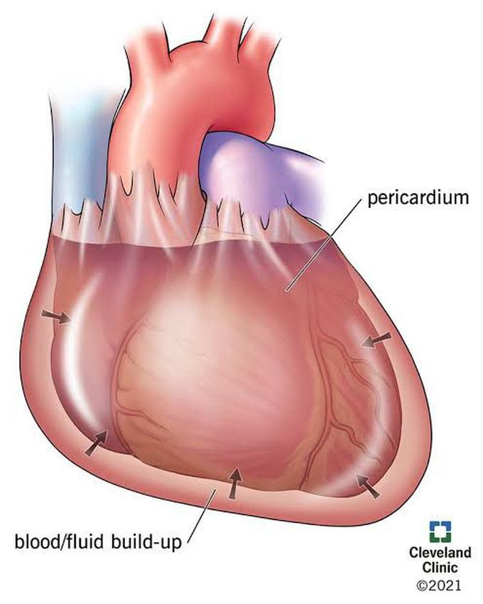 How to manage cardiac temponade?