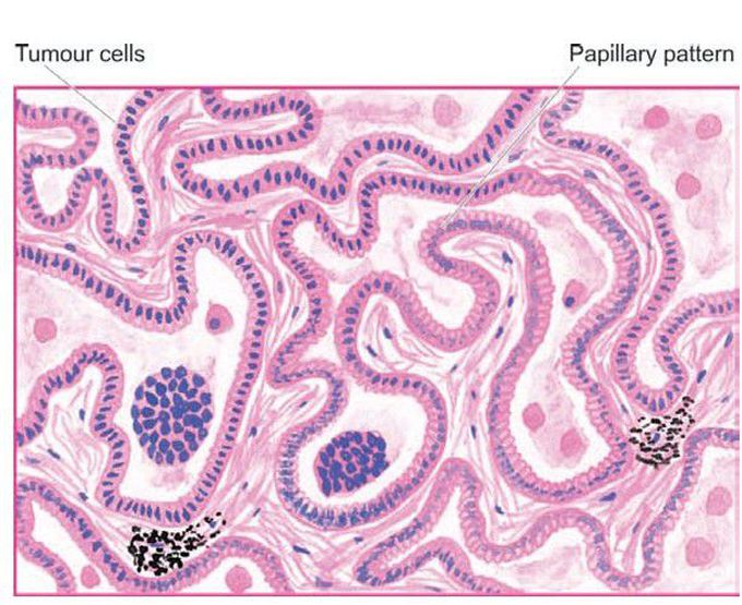 Bronchioloalveolar carcinoma