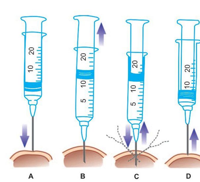 Procedure for FNAC of palpable masses