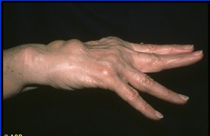 What's the name of this sign in rheumatoid arthritis?!!