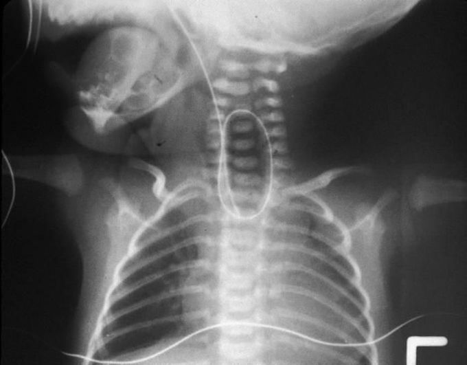 Tracheoesophageal Fistula The Coiled Ng Tube On X Ray Medizzy