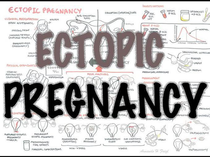 Ectopic Pregnancy - (DETAILED) Overview