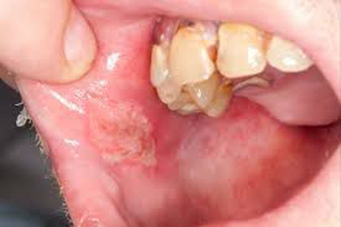 Treatment of behcet syndrome