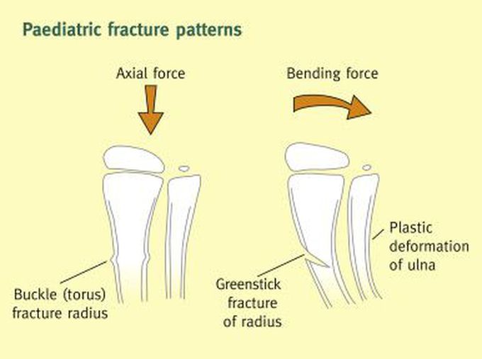 Greenstick Fracture vs Torus Fracture