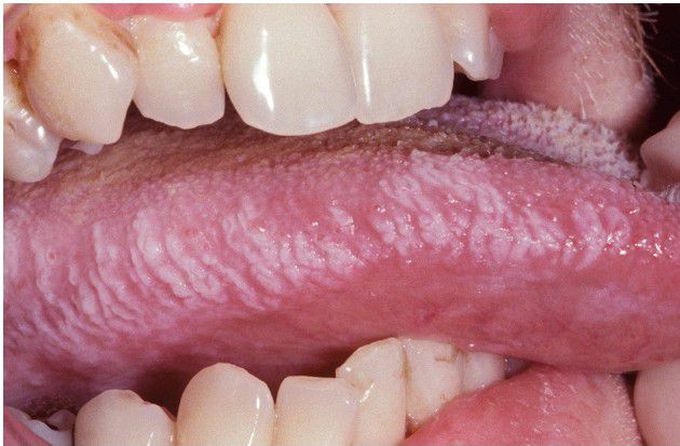 HIV-associated Oral Hairy Leukoplakia (OHL).