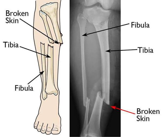 Compound fracture