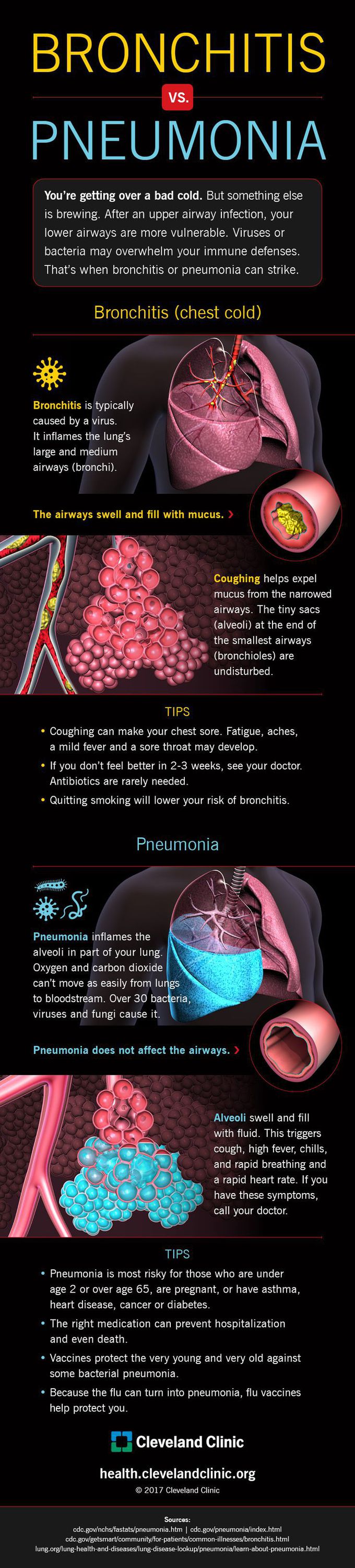 Feeling Lousy? How to Tell If It's Bronchitis or Pneumonia (Infographic)