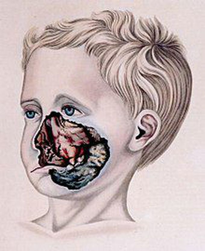 Noma disease causes