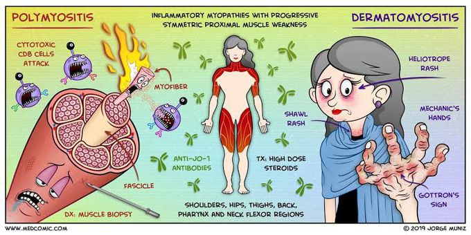 Polymyositis and Dermatomyositis