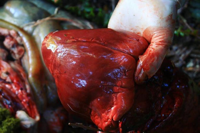 Myocardial infarction (MI)