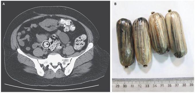 Ingestion of Lead-Contaminated Packs of Opium