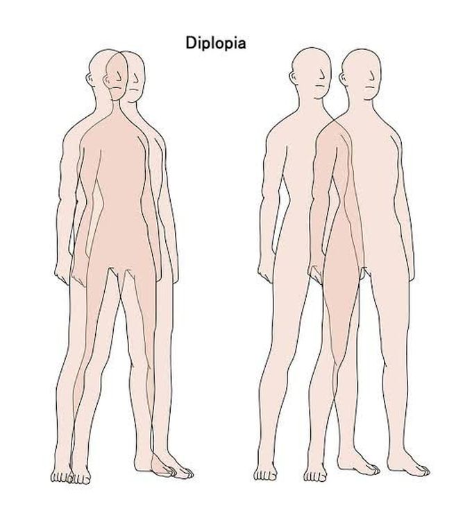 Diplopia