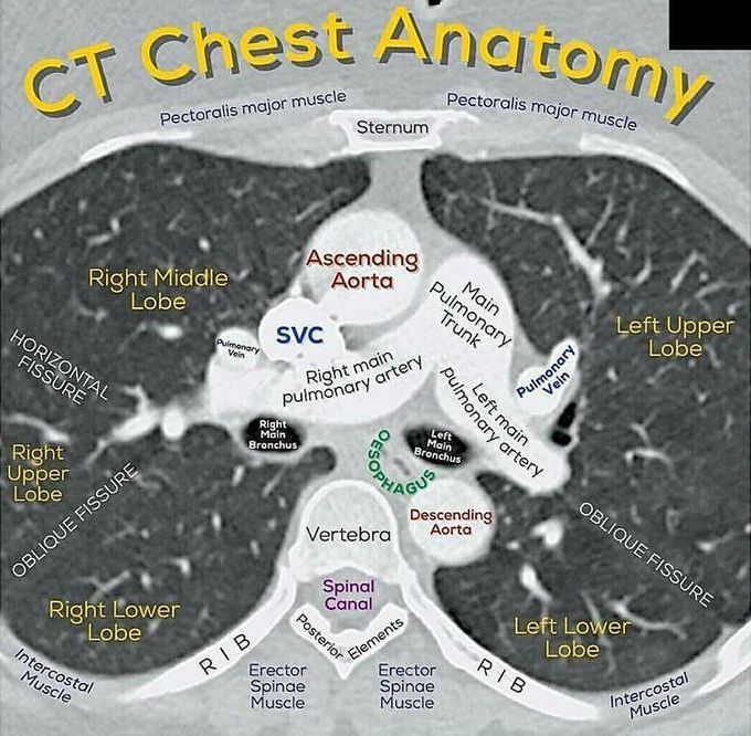 Chest CT