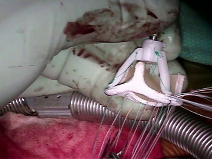 Aortic Valve Replacement with a Pericardial Tissue Valve