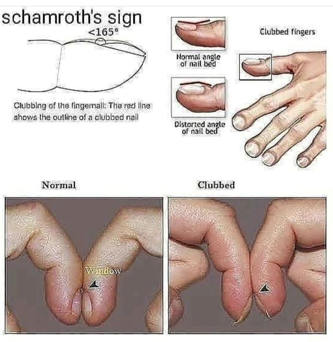 Schamroth's Sign