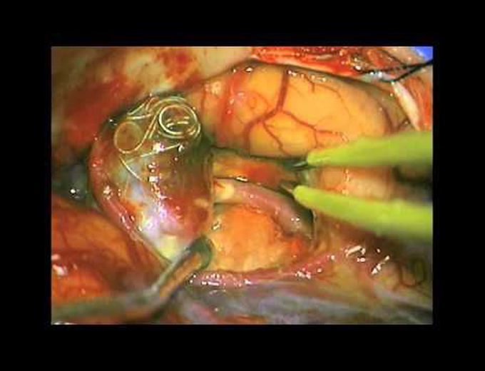 Microsurgical treatment of recurrent coiled aneurysms