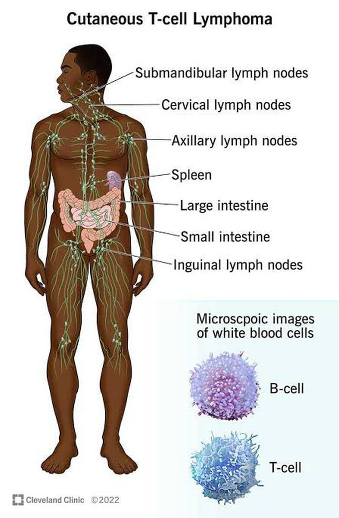 Cutaneous T Cell Lymphoma
