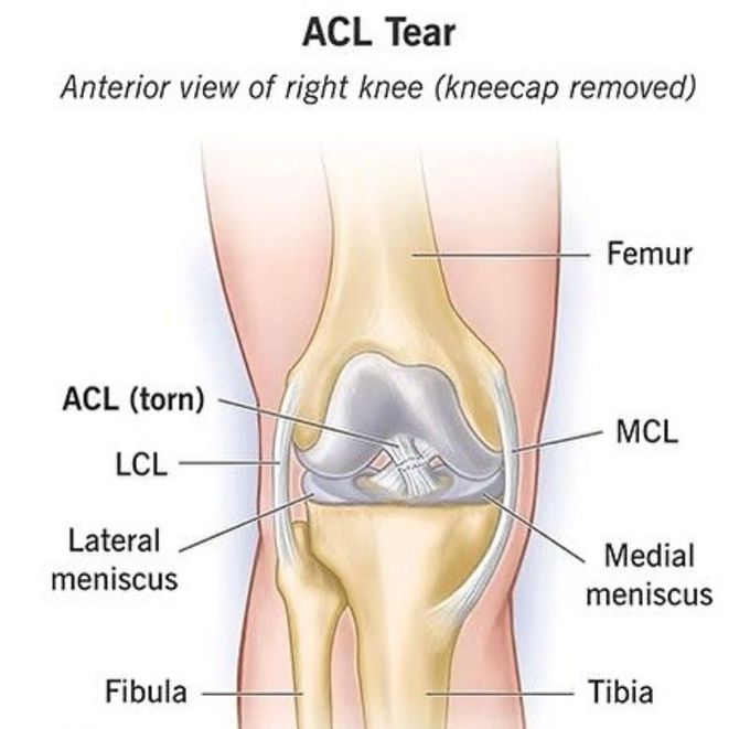 ACL Tear