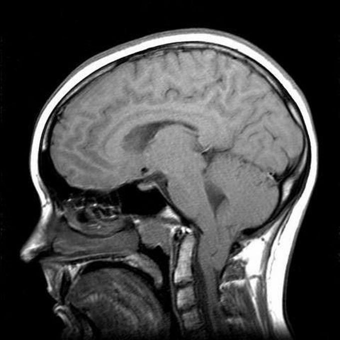 Chiari Malformation