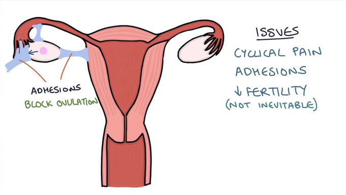 Endometriosis