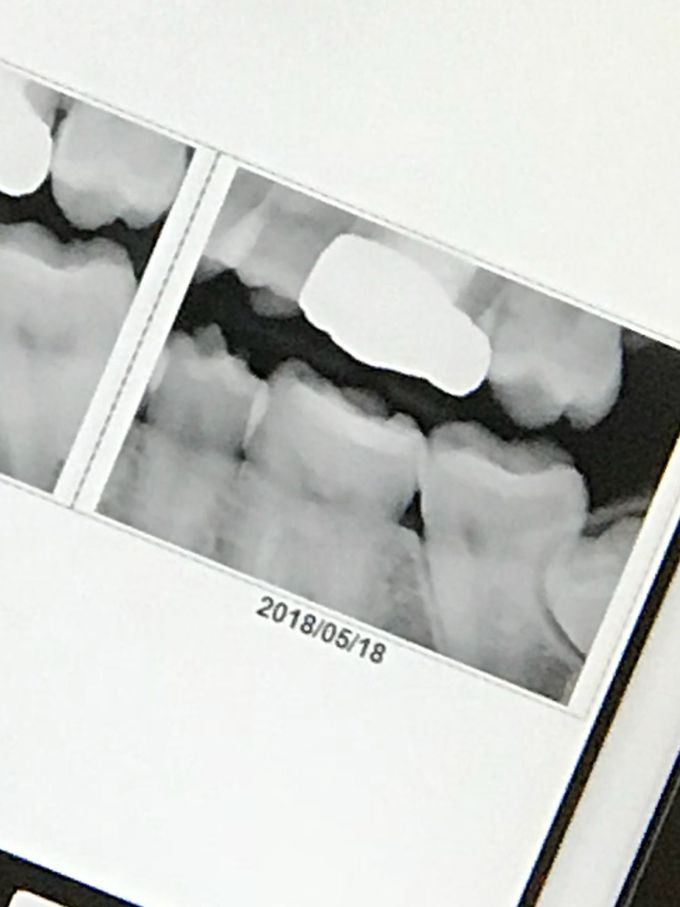 How to know if it’s wisdom teeth pain...