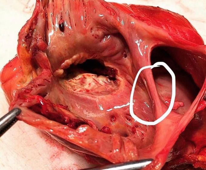 An enormous atrial septal defect (ASD) found in the heart of a 50 year old man!