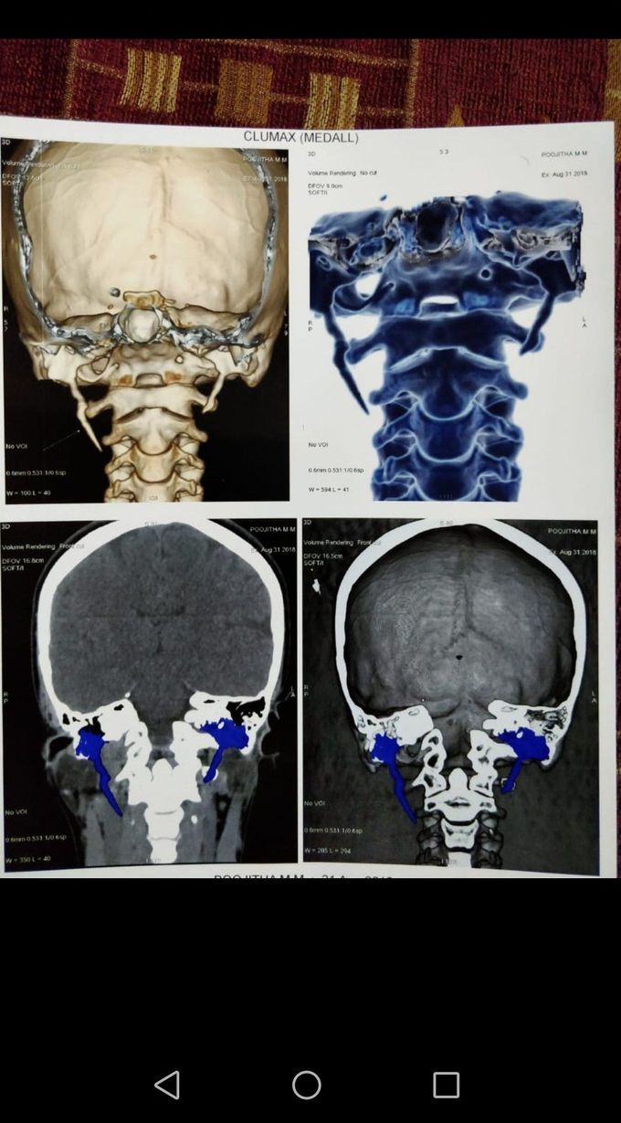 ELONGATED STYLOID PROCESS