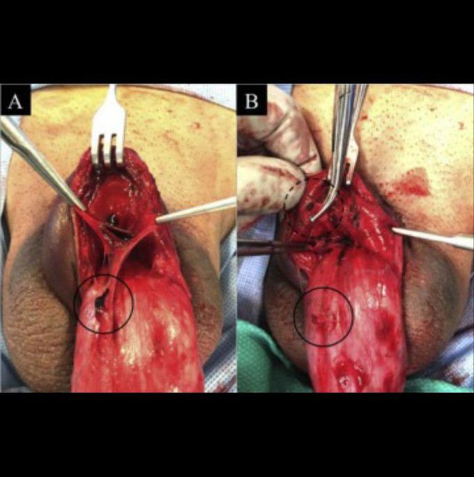 Superficial Dorsal Venous Rupture of the Penis: False Penile Fracture That Needs to be Treated as a True Urologic Emergency