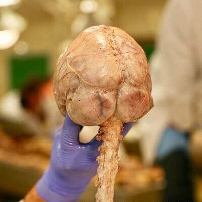 Brain and spinal cord with dural membranes (meninges) still intact, and viewed posteriorly