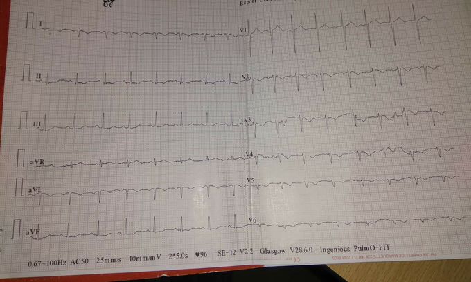 diagnose the  ecg...