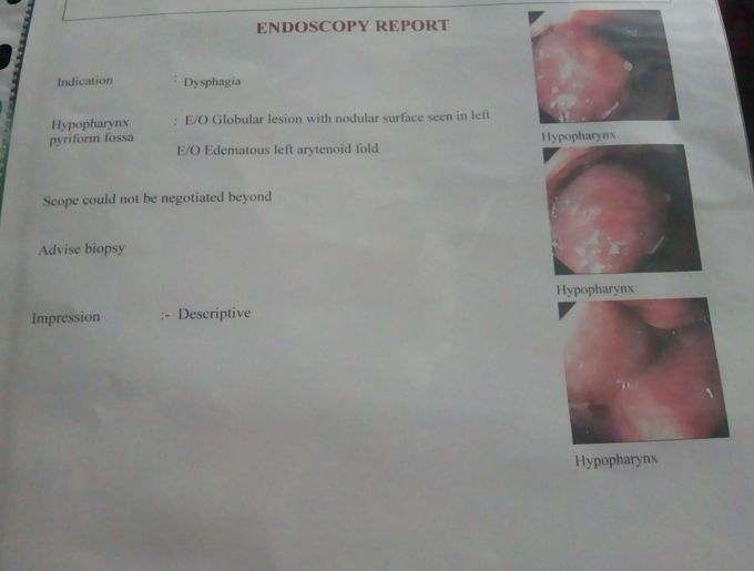 Dysphagia #globular#lesion #nodularsurface