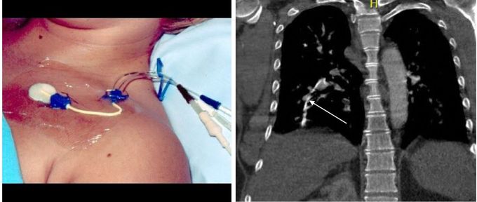Remnant of Central Venous Catheter can Cause Sepsis