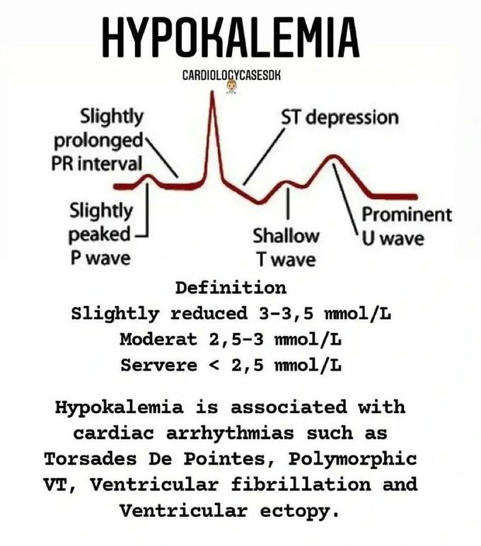 Hypokalemia