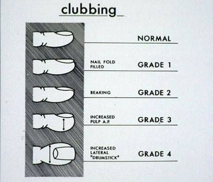 Grades of clubbing