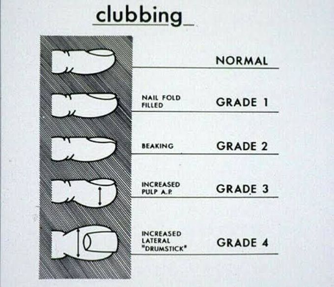 Grades Of Clubbing MEDizzy