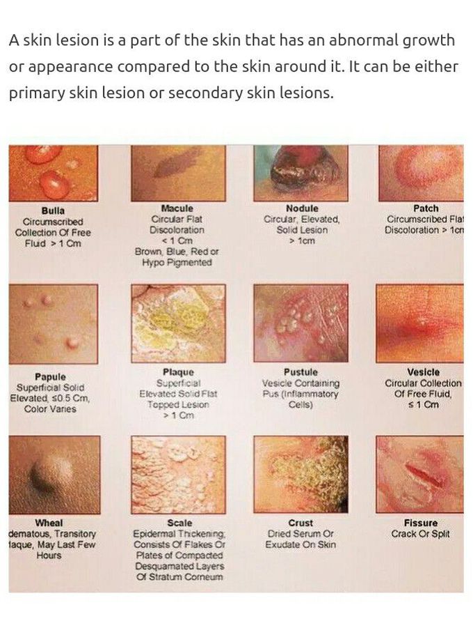 Skin lesions