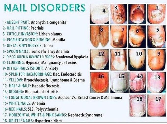 Different types of nail disorders