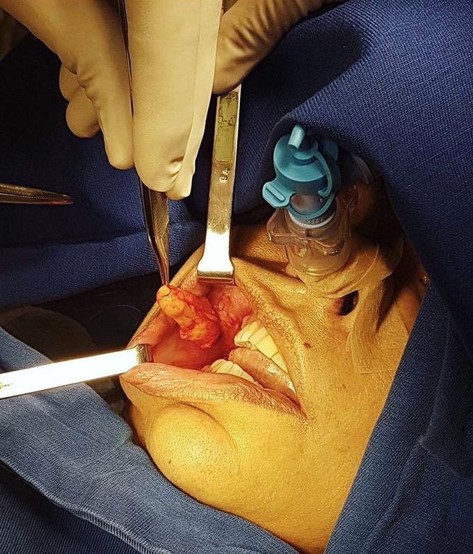Bichectomy - buccal fat pad removal