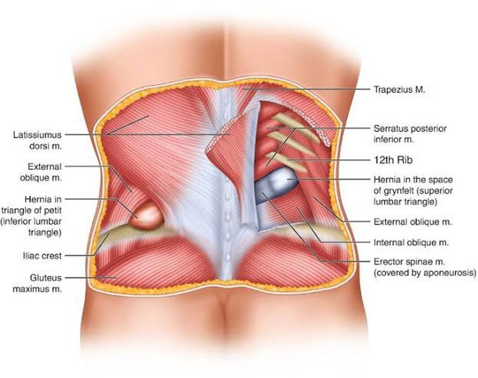 Lumbar hernia