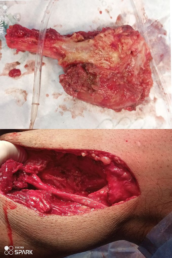 GAINT CELL TUMOR (Fibular head)