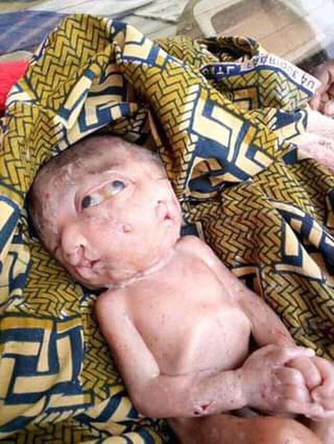 Low birth weight
