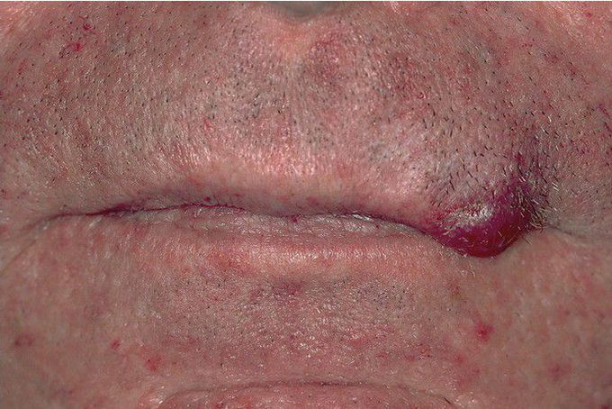 Merkel Cell Carcinoma.