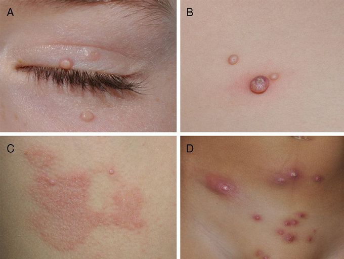 molluscum contagiosum