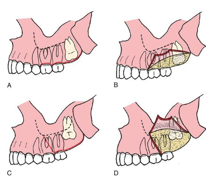 Impacted tooth removal