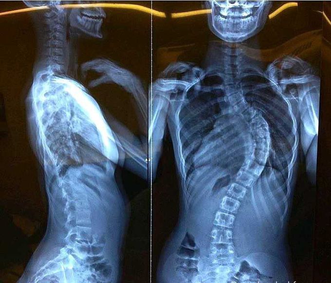 Sclerosis 😐