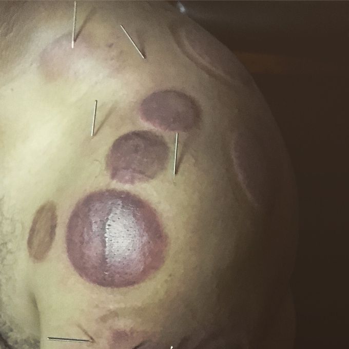 Acupuncture