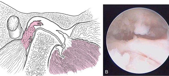 Arthroscopic findings in degenerative joint disease