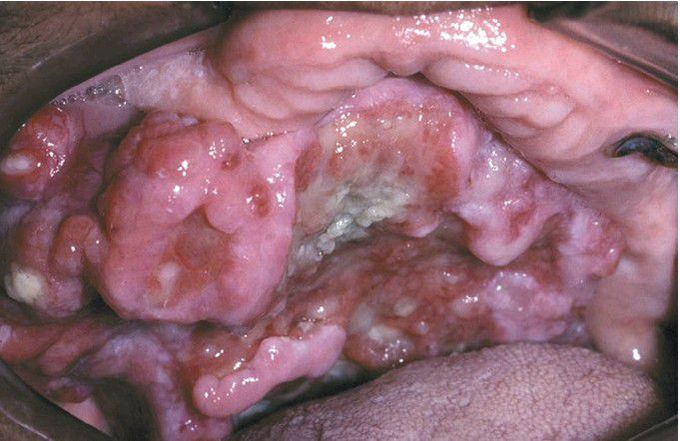 Carcinoma Ex Pleomorphic Adenoma