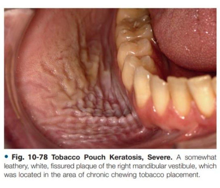 Severe Tobacco Pouch Keratosis